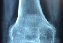 Pentingnya Menjaga Kesehatan Tulang untuk Mencegah Osteoporosis