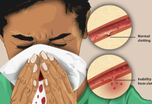 Hemofilia: Penyakit Langka yang Mempengaruhi Kualitas Hidup