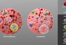 Melawan Leukemia: Perjuangan Melawan Kanker Darah yang Mematikan